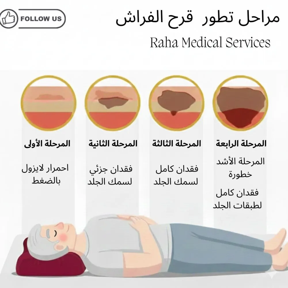 مراحل تطور القرح